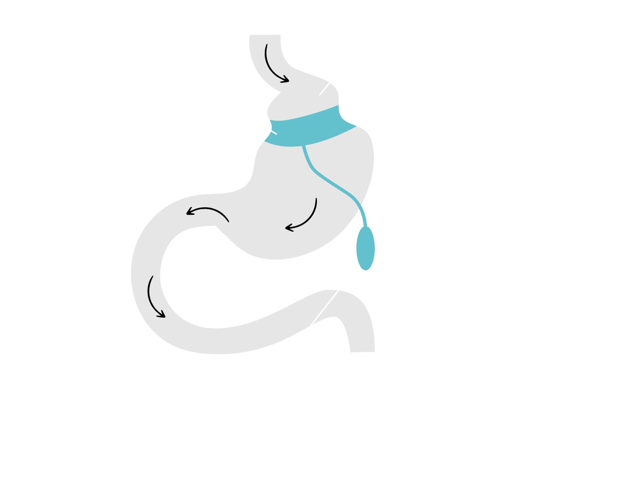 Operacja rewizyjna - przed zabiegiem